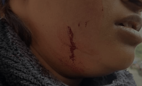 A Woman in Lucknow attacked by Dogs in A Housing Campus